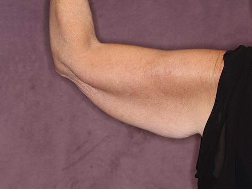 Case--37368 | Before Arm Lift 4