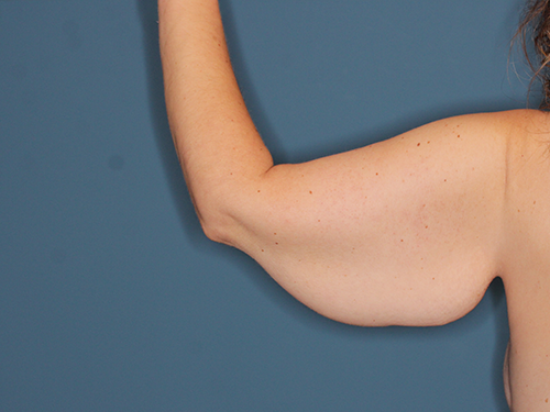 Case--43683 | Before Arm Lift 3