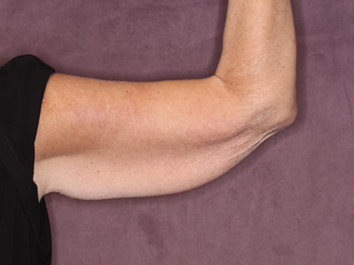 Case--37368 | Before Arm Lift 3