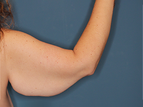Case--43683 | Before Arm Lift 4