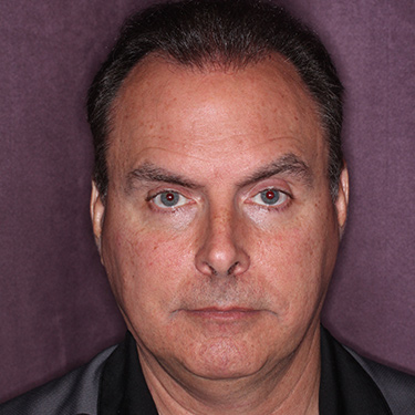 Case--36831 | Before Facelift and Neck Lift for Men 1