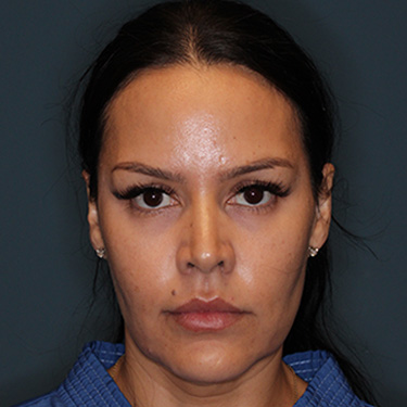 Case--42025 | Before Facelift and Neck Lift 1