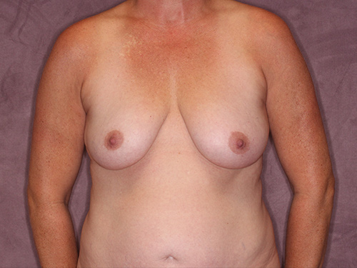Case--37112 | Before Breast Augmentation and Breast Lift 1