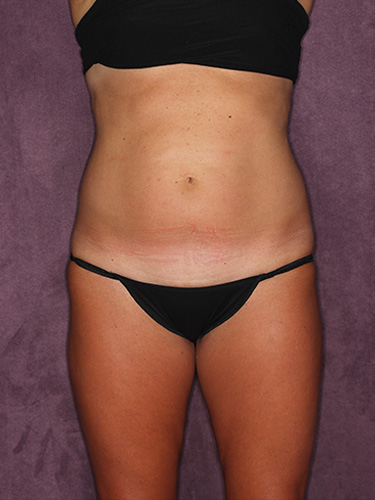Case--39748 | Before Liposuction 1