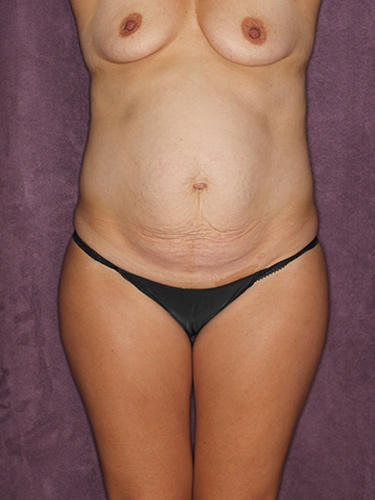 Case--36375 | Before Mommy Makeover 1
