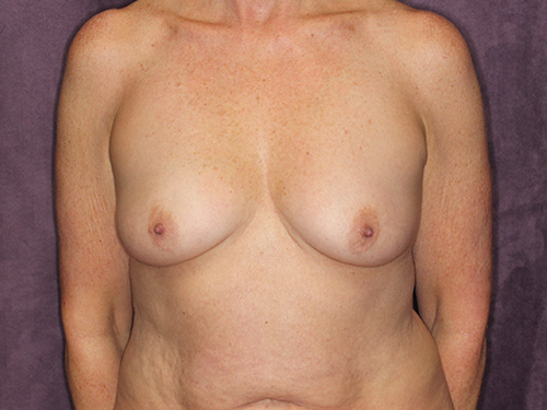 Case--32275 | Before Breast Augmentation 1