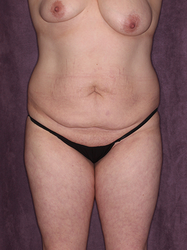 Case--37146 | Before Liposuction 1