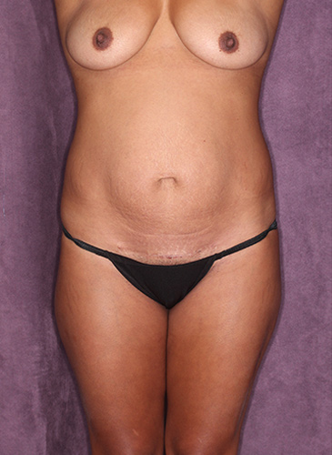 Case--37058 | Before Liposuction 1