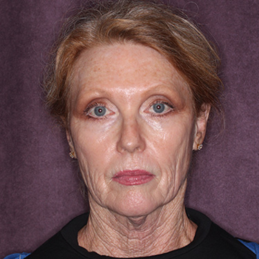 Case--36727 | Before Facelift and Neck Lift 1