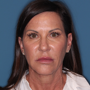 Case--37967 | Before Facelift and Neck Lift 1