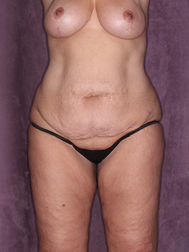 Case--39430 | Before Fat Transfer to Buttocks 1