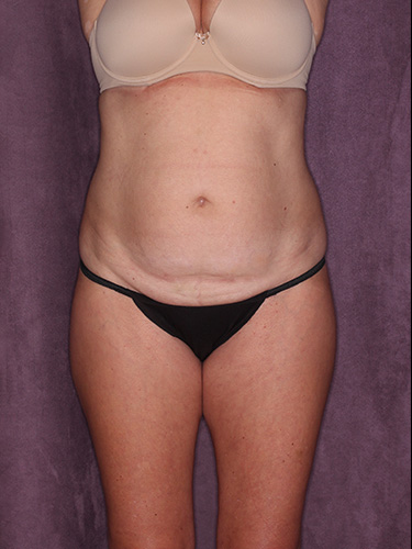 Case--39548 | Before Liposuction 1