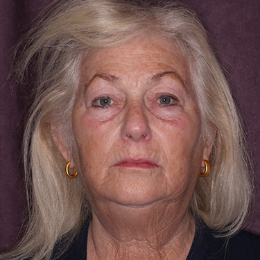 Case--39696 | Before Eyelid Surgery (Blepharoplasty) 1