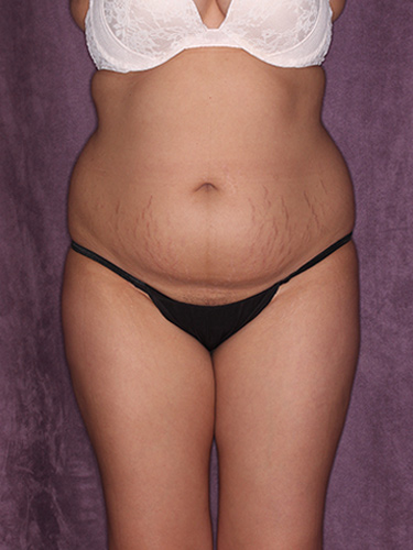Case--37319 | Before Fat Transfer to Buttocks 1
