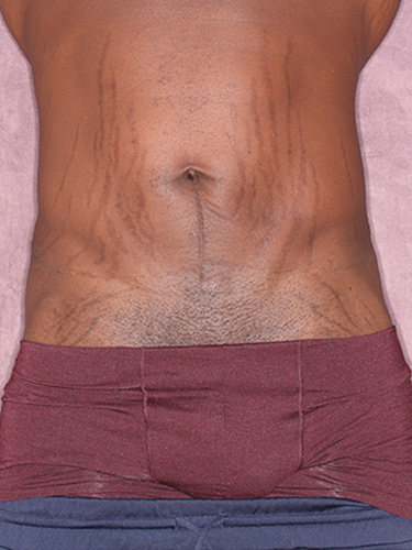 Case--36791 | Before Body Lift for Men 1