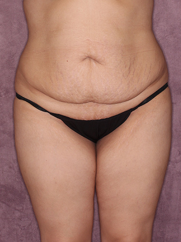 Case--37542 | Before Liposuction 1