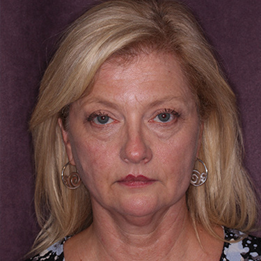 Case--36776 | Before Brow Lift 1