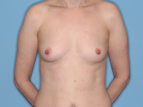 Case--40123 | Before Breast Augmentation 1
