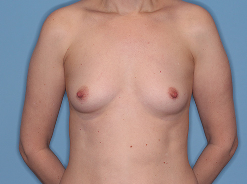 Case--37781 | Before Breast Augmentation 1