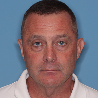 Case--41459 | Before Facelift and Neck Lift for Men 1