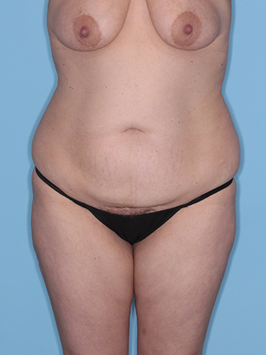 Case--37797 | Before Fat Transfer to Buttocks 1
