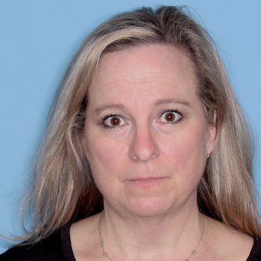 Case--36591 | Before Facelift and Neck Lift 1