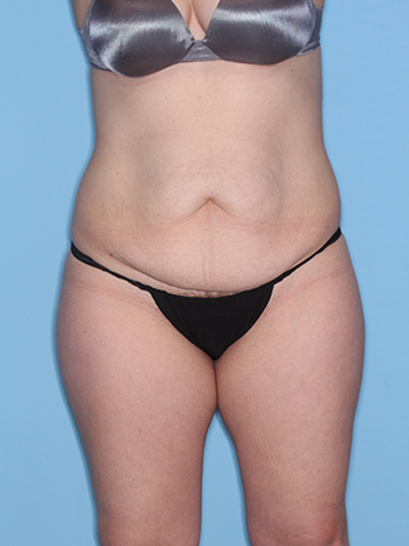 Case--38188 | Before Liposuction 1