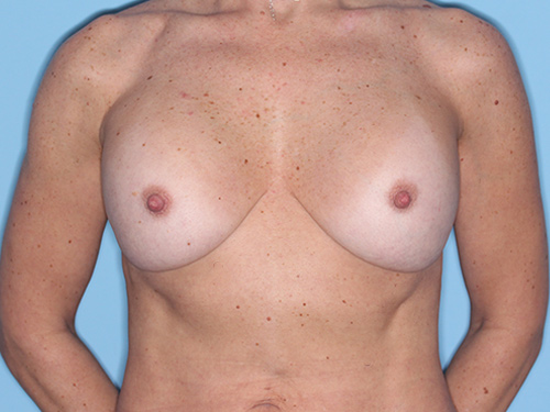 Case--37073 | Before Corrective/Revision Breast Implant Surgery 1