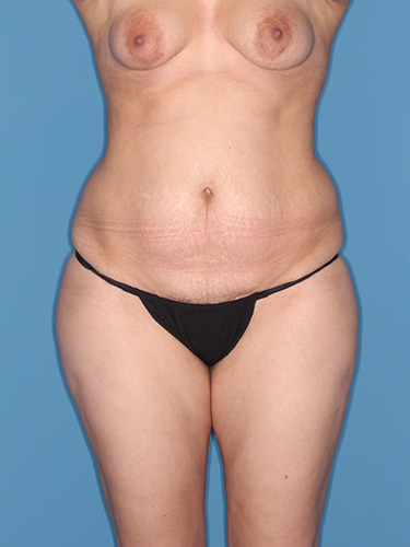 Case--39495 | Before Liposuction 1