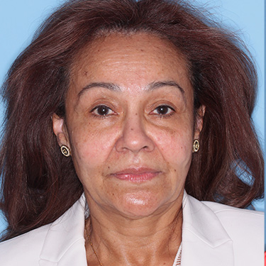 Case--38938 | Before Eyelid Surgery (Blepharoplasty) 1