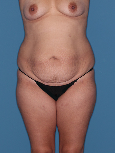 Case--41922 | Before Fat Transfer to Buttocks 1