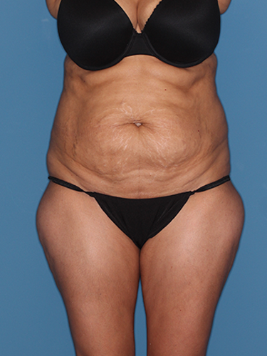 Case--43533 | Before Liposuction 1