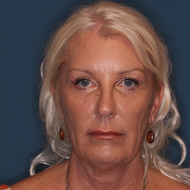 Case--40232 | Before Facelift and Neck Lift 1