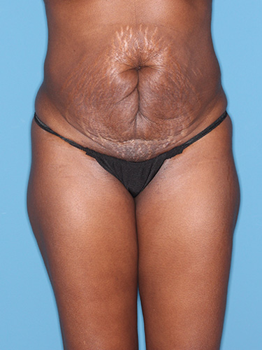 Case--39563 | Before True Form Tummy Tuck® 1