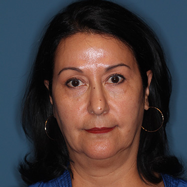Case--40089 | Before Eyelid Surgery (Blepharoplasty) 1