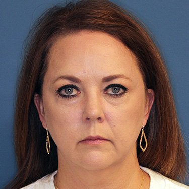 Case--40200 | Before Facelift and Neck Lift 1