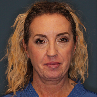 Case--43126 | Before Eyelid Surgery (Blepharoplasty) 1