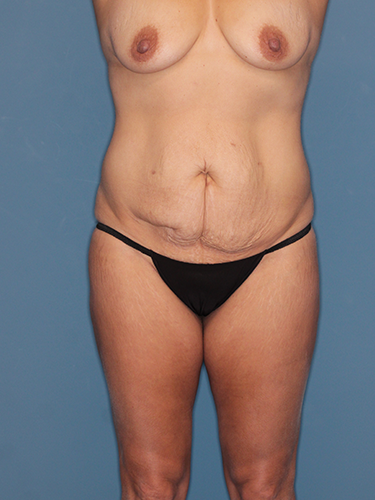 Case--169556 | Before True Form Tummy Tuck® 1