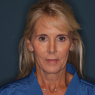 Case--837079 | Before Brow Lift 1
