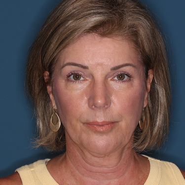 Case--38239 | Before Eyelid Surgery (Blepharoplasty) 1