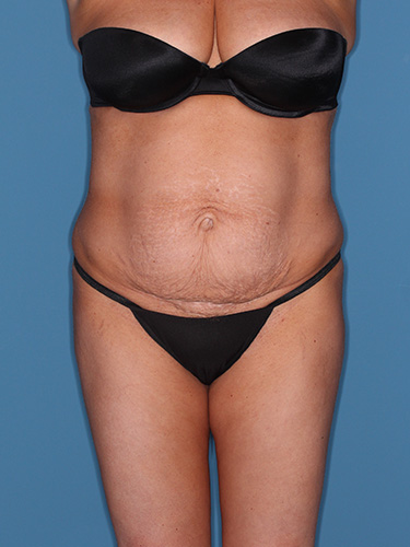Case--39166 | Before True Form Tummy Tuck® 1