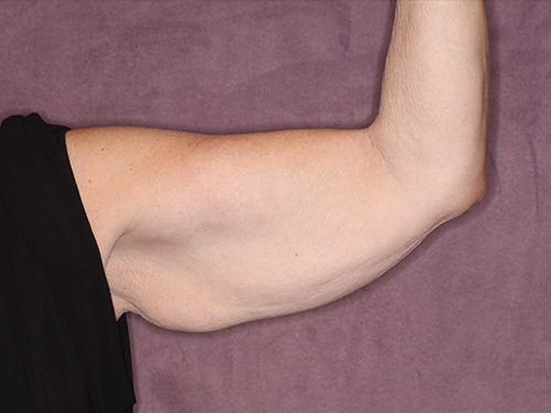 Case--37368 | Before Arm Lift 2