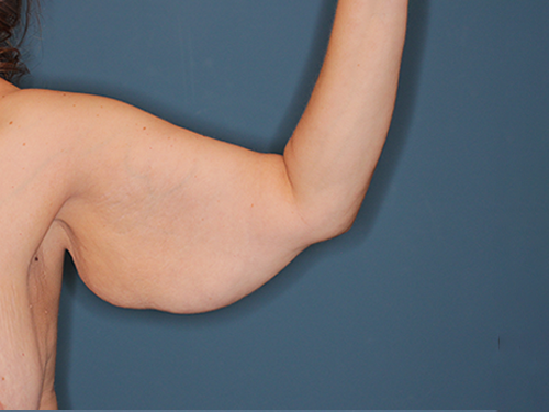 Case--43683 | Before Arm Lift 2