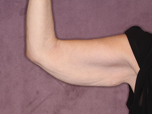 Case--37368 | Before Arm Lift 1