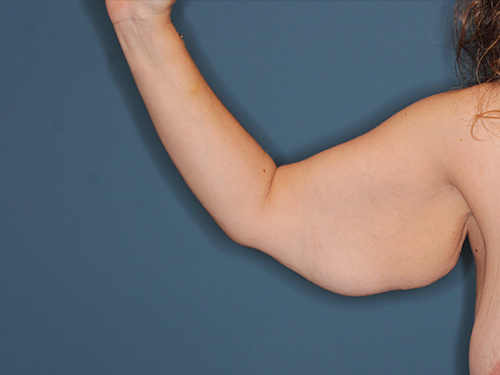 Case--43683 | Before Arm Lift 1