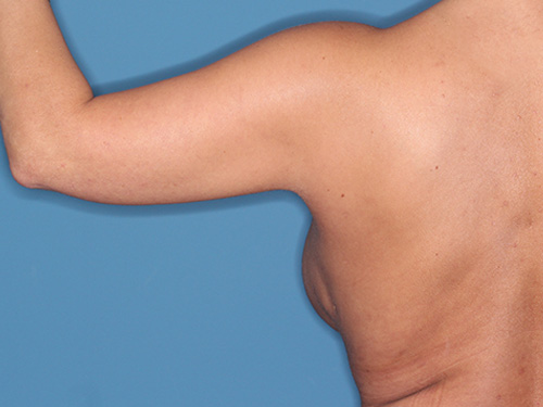 Case--40562 | Before Arm Lift 4