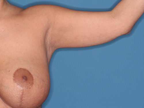 Case--40562 | Before Arm Lift 2
