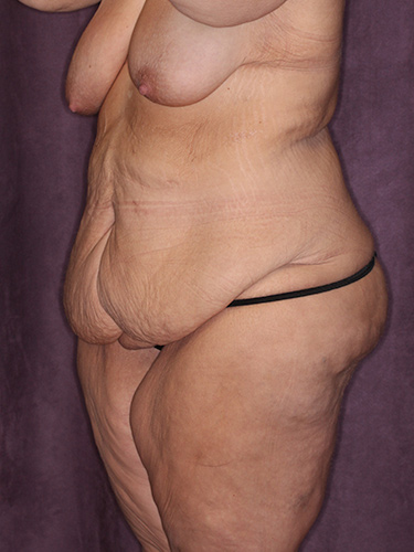 Case--39643 | Before Thigh Lift 3