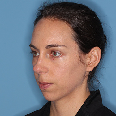 Case--36005 | Before Nose Surgery (Rhinoplasty) 4