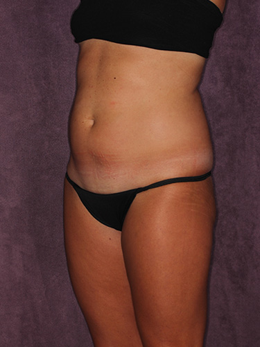 Case--39748 | Before Liposuction 3